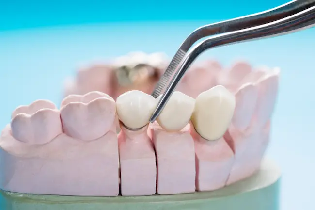 ماجستير تركيبات الأسنان Master of Prosthodontics _ كيف تكون دراسة ماجستير تركيبات الأسنان في مصر؟!
