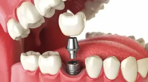 ماجستير تركيبات الأسنان Master of Prosthodontics في مصر